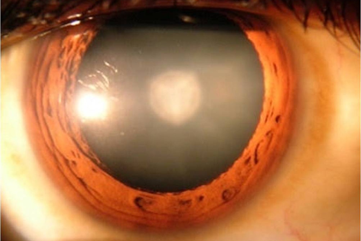 Importante evitar ceguera por retinopatía diabética