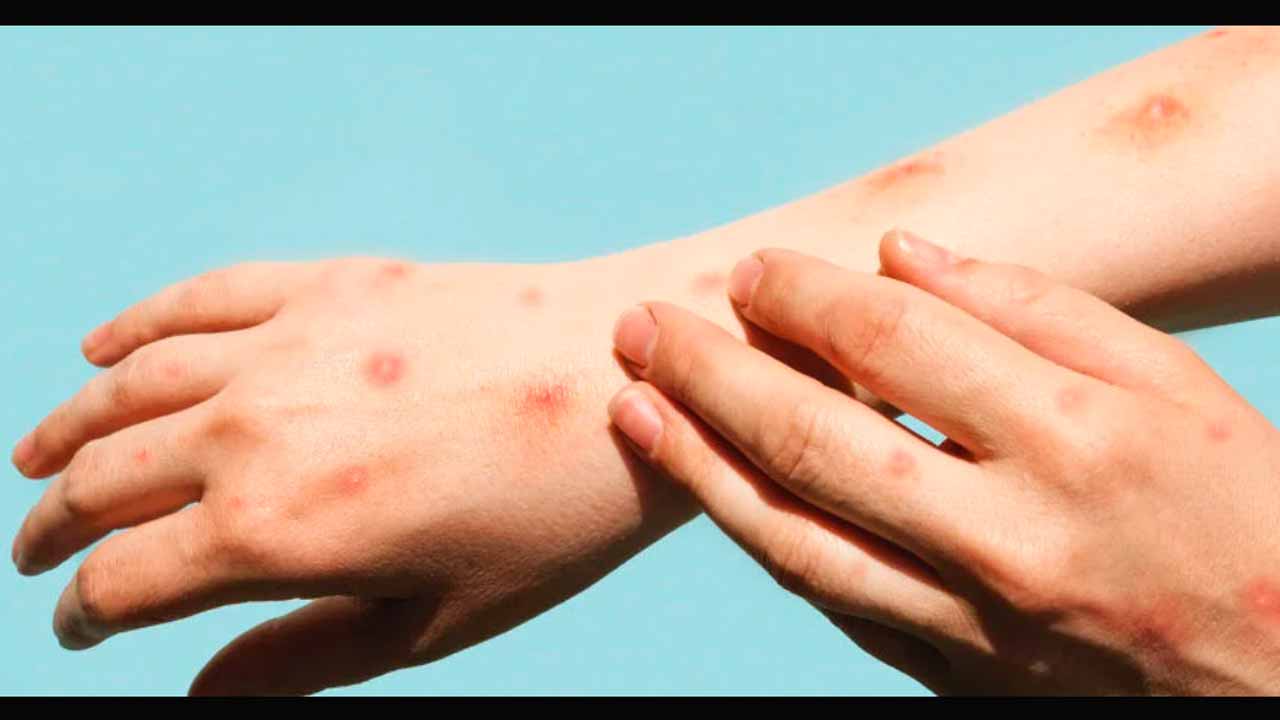 OMS declara emergencia de salud pública por el brote de viruela símica (mpox), conoce más de esta enfermedad
