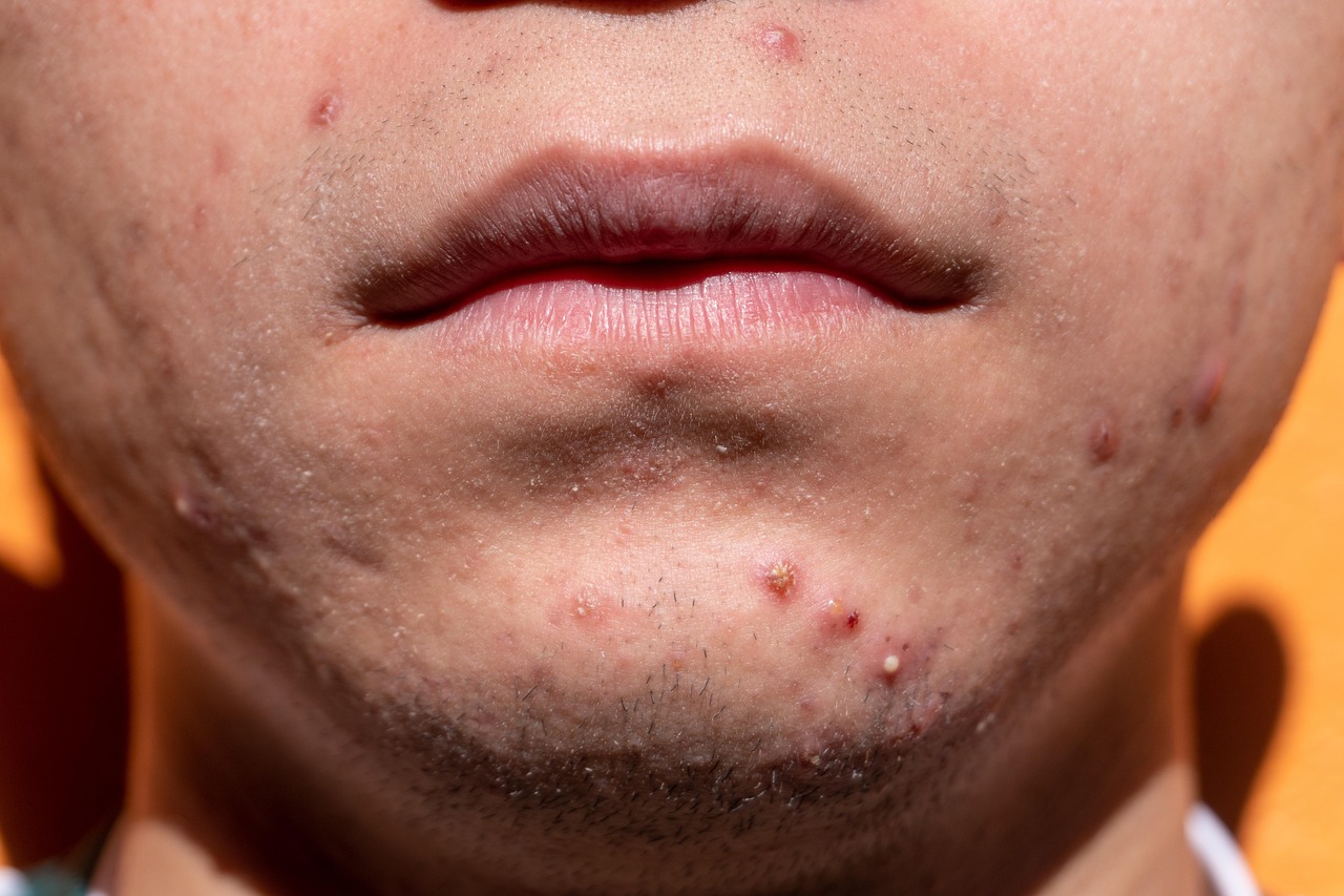 Dermatitis atópica afecta la autoestima de jóvenes y niños