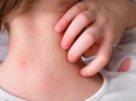 Menores de 1 a 9 años concentran más de 2 mil 400 contagios por sarampión en el país Menores de 1 a 9 años concentran más de 2 mil 400 contagios por sarampión en el país